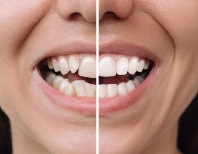 The Benefits of Cosmetic Dentistry: Procedures, Options, and Smile Enhancement