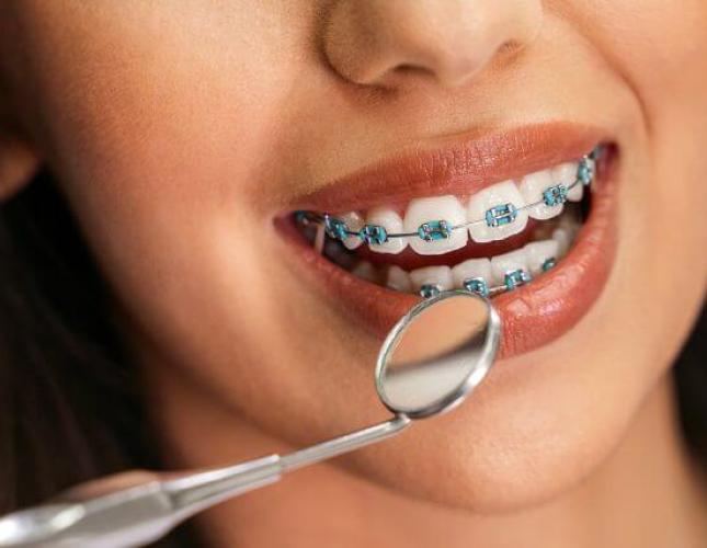 Your Guide to a Perfect Smile with Traditional Braces